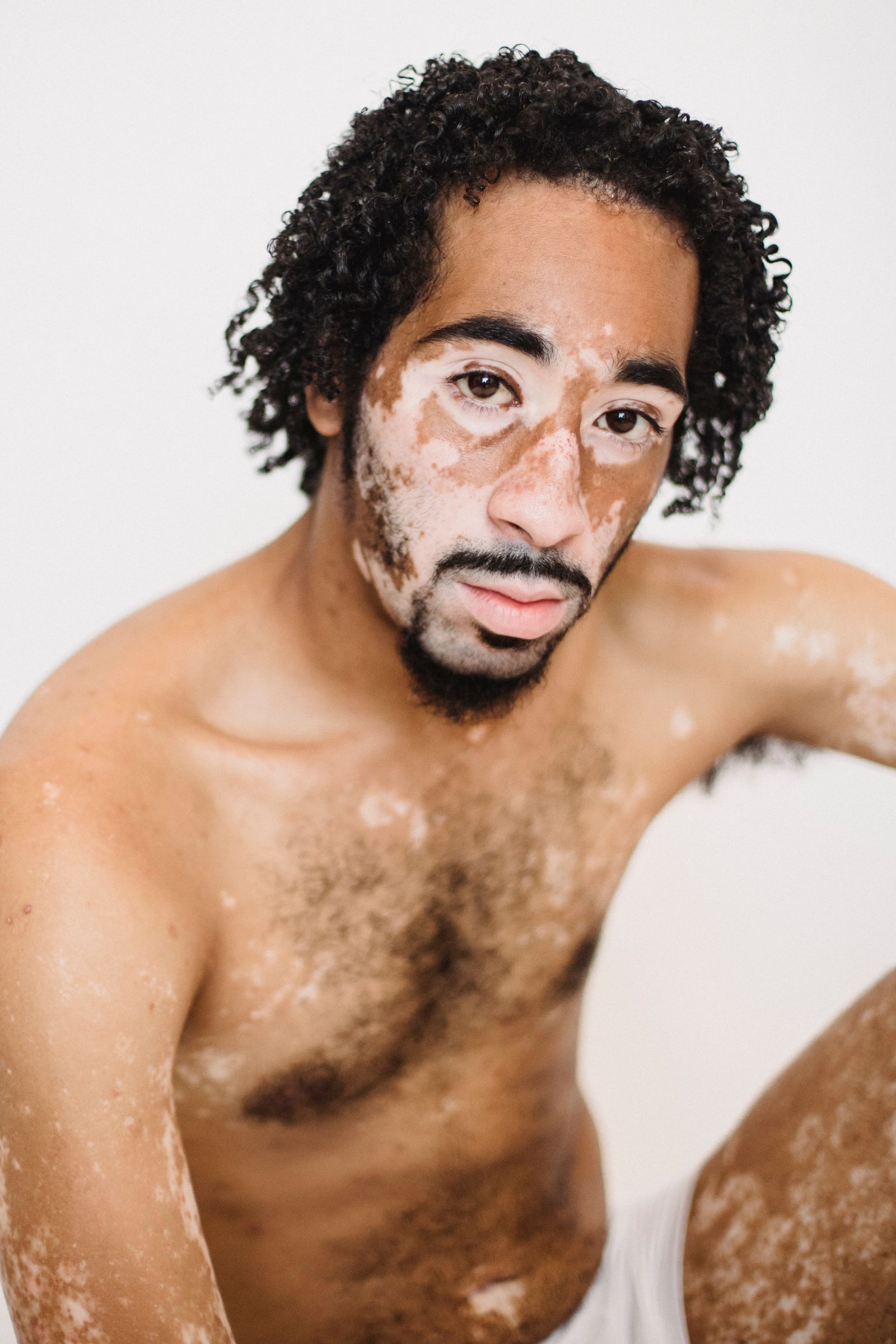White depigmented vitiligo patches on hand skin
