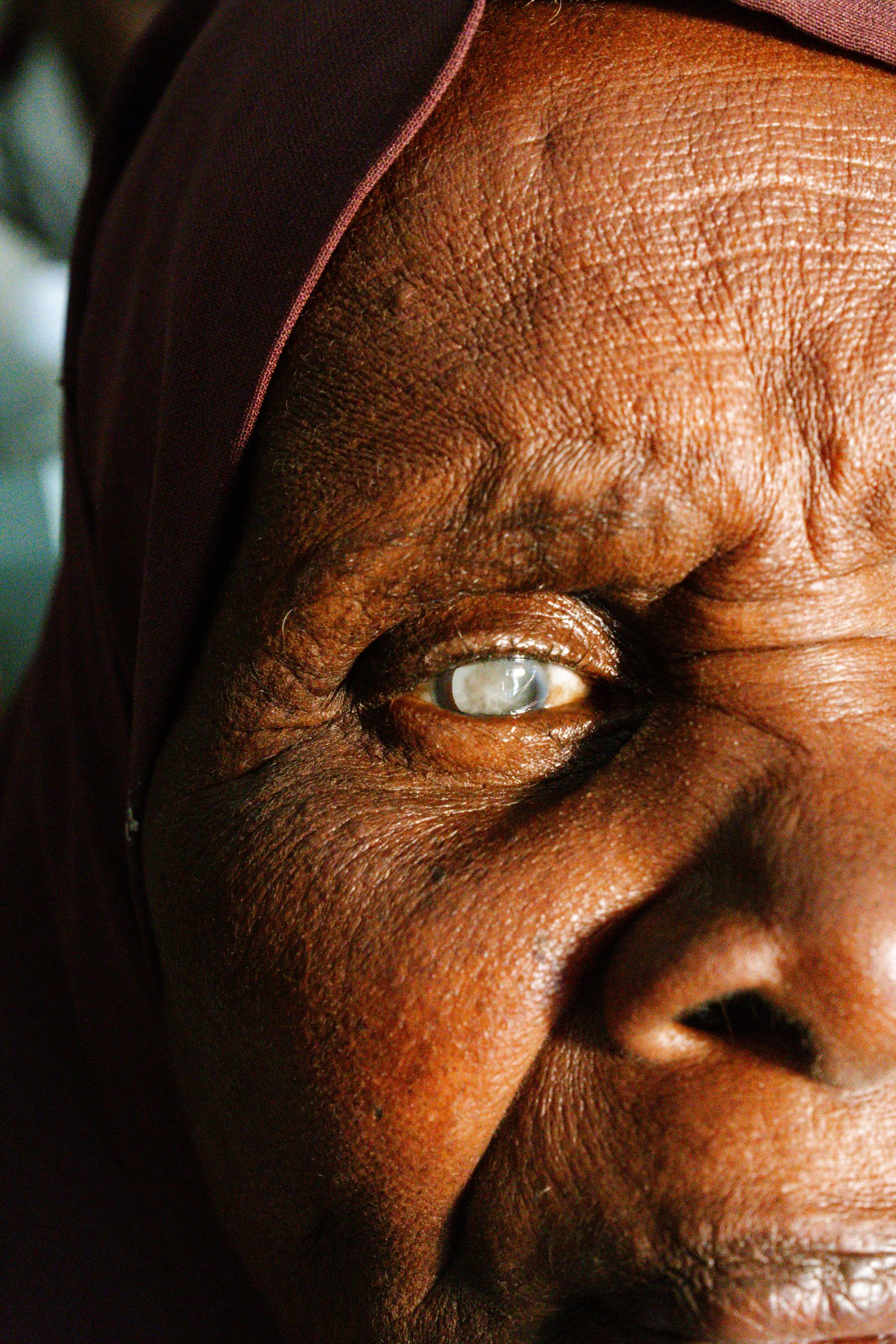 Close-up of an eye showing cloudy lens from cataract