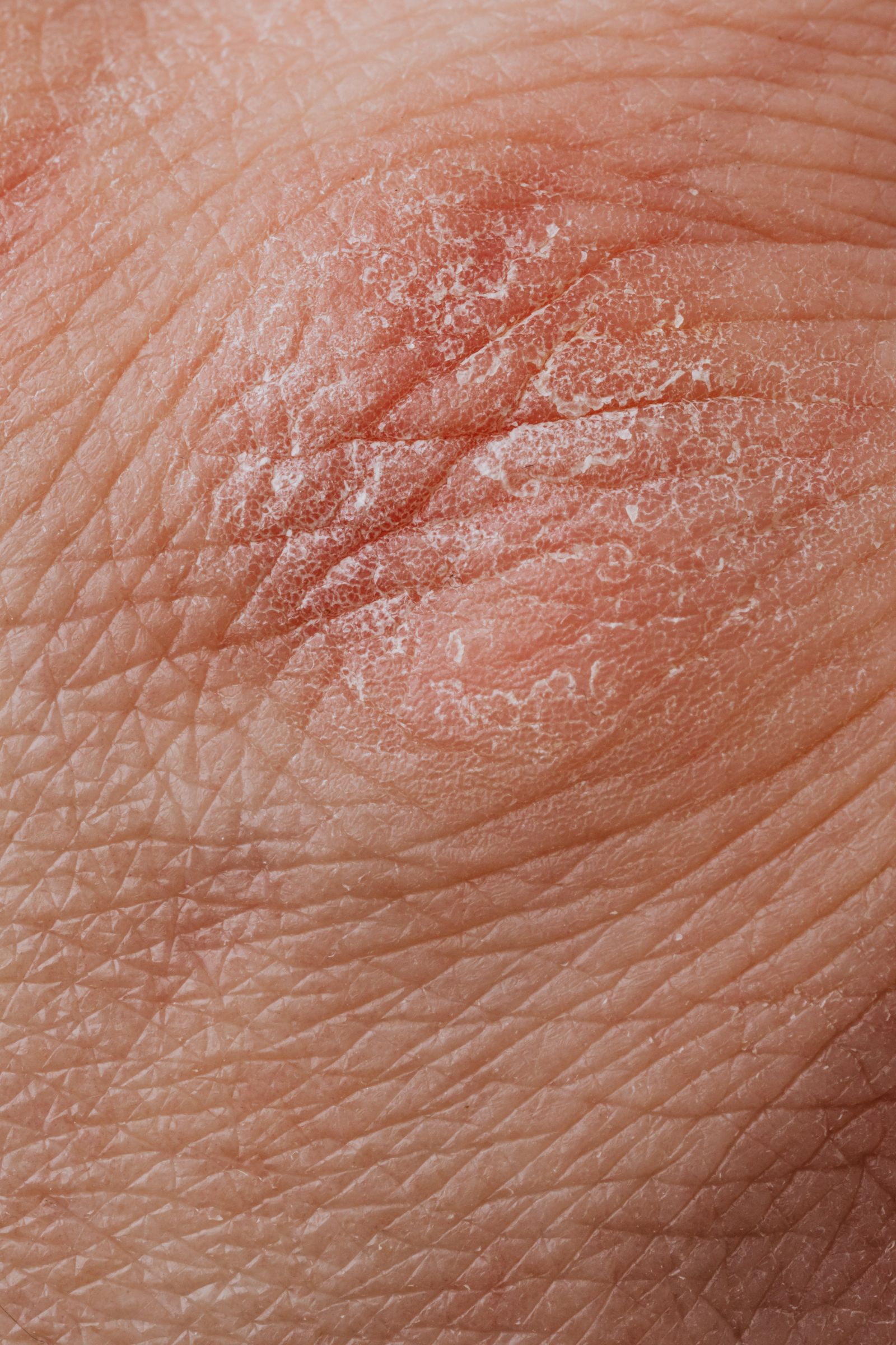 Silvery-scaled psoriasis plaques on elbow skin